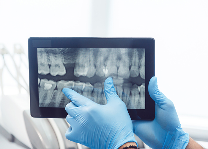 What are the Benefits of a Dental X-Ray?