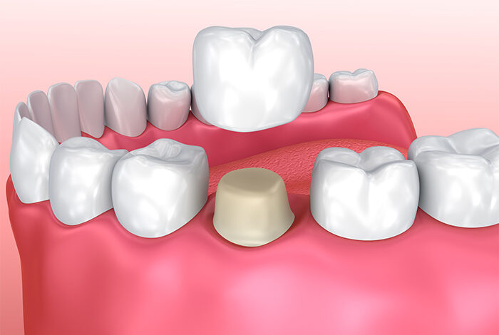 Dental Crowns Services by Moira Wong Orthodontics - dental clinic in Kensington, London