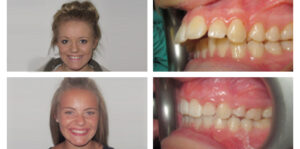 Molly Before & After Braces