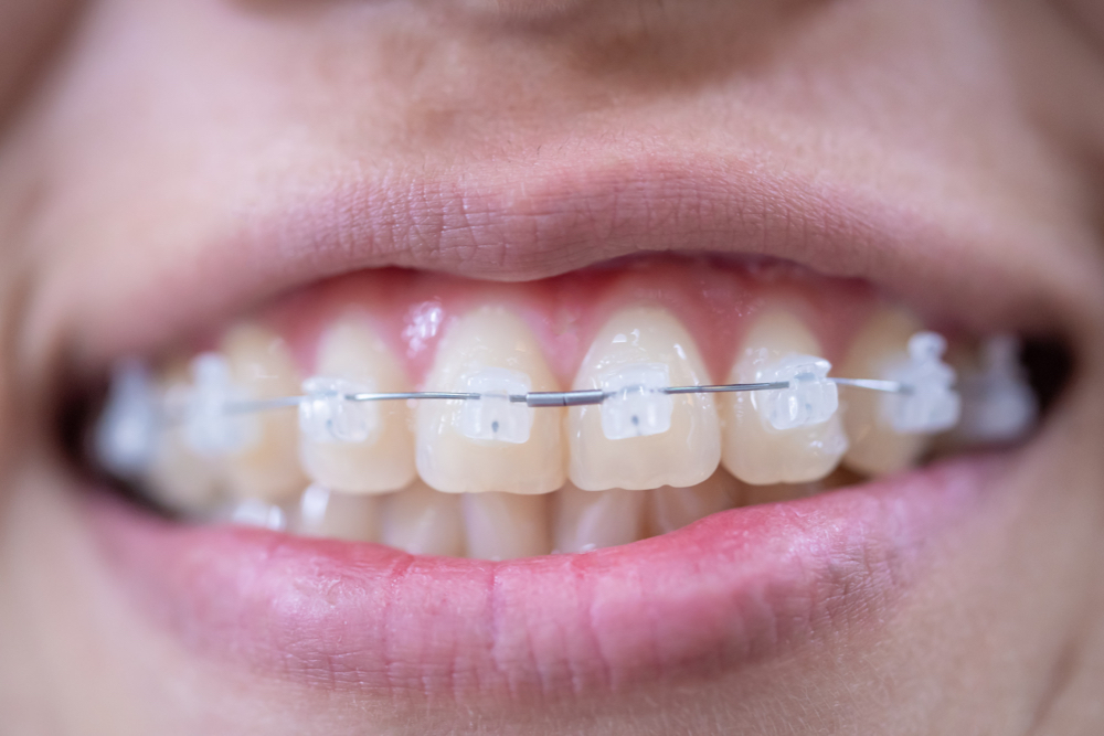 Clear fixed braces