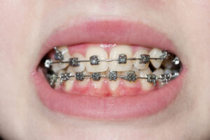 Metal fixed braces